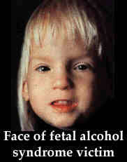Fetal Alcohol Syndrome